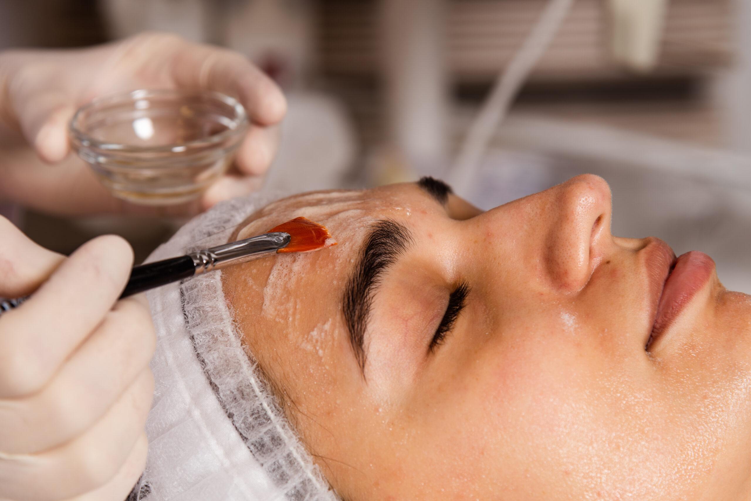 Chemical Peels